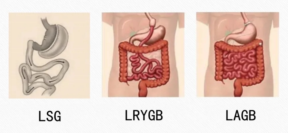 Types of Bariatric and Metabolic Surgery